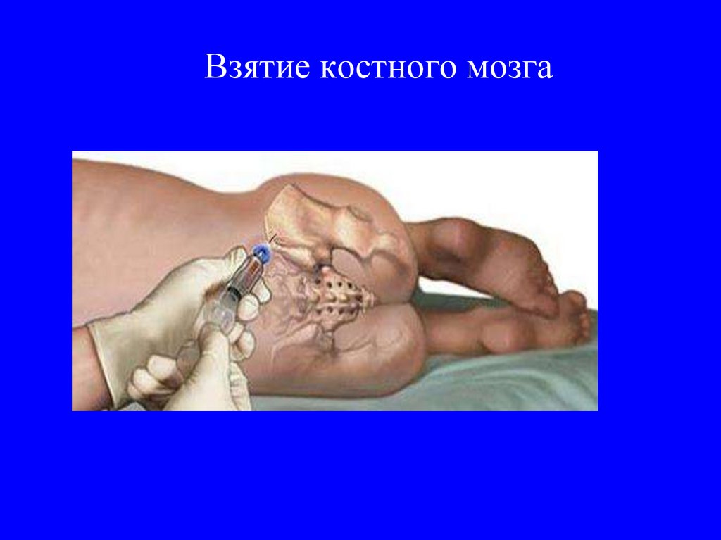 Взятие костного мозга