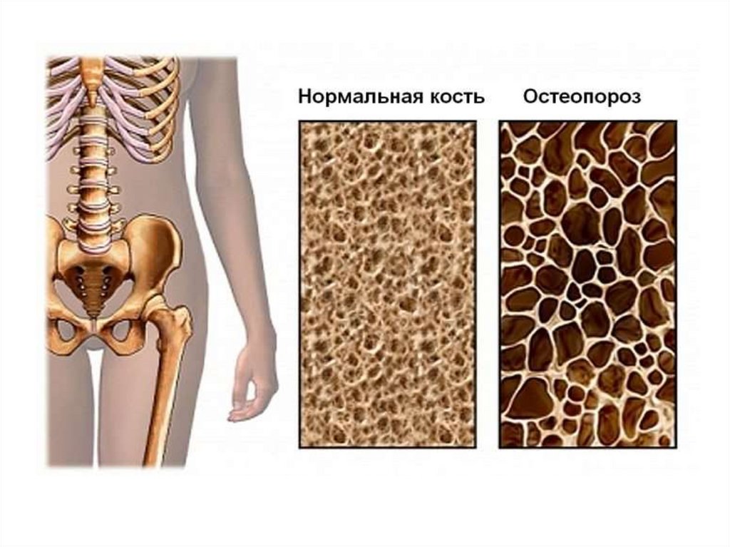 Снижение плотности костей