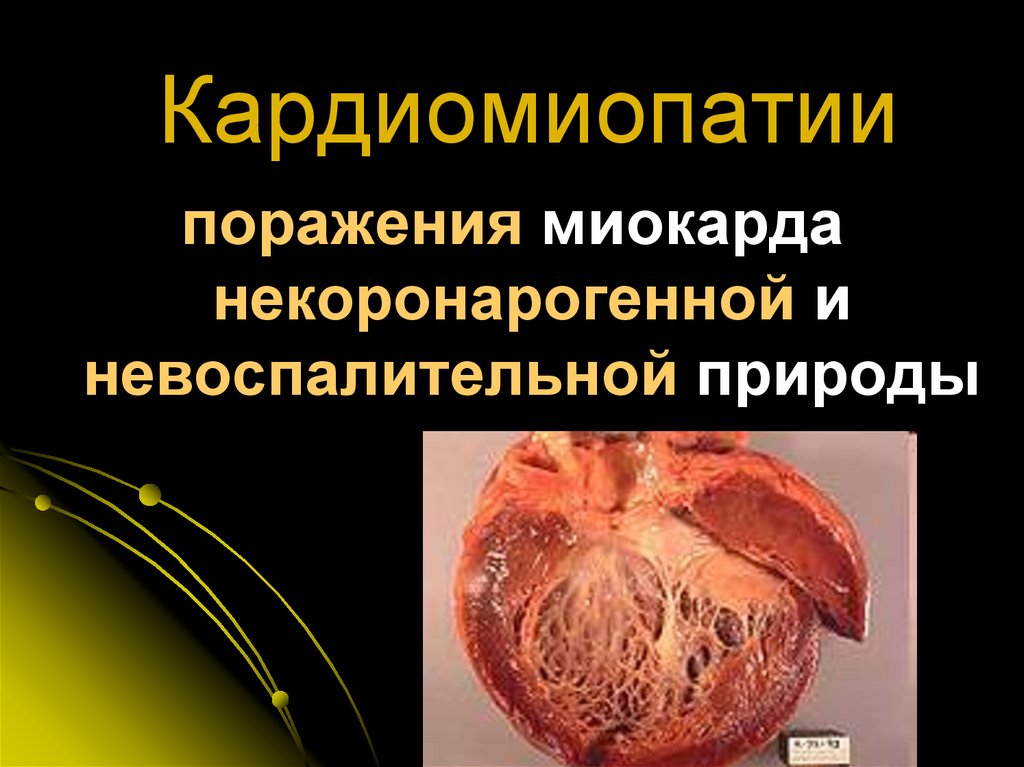 Кардиомиопатии