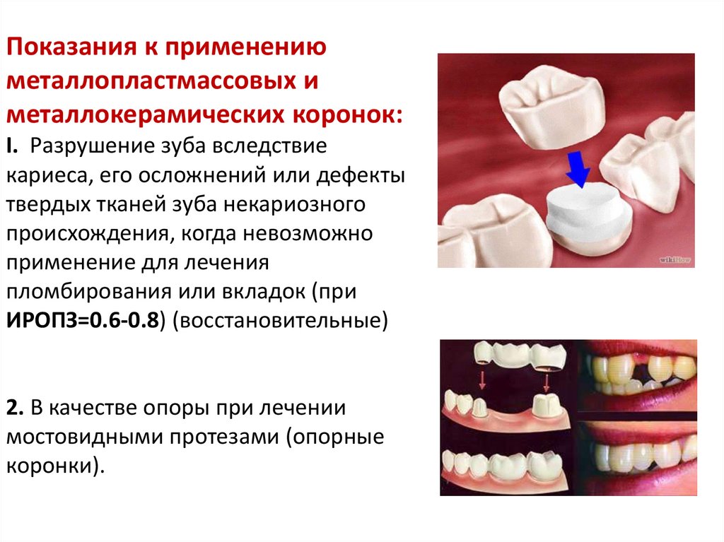 Изготовление пластмассовых коронок презентация