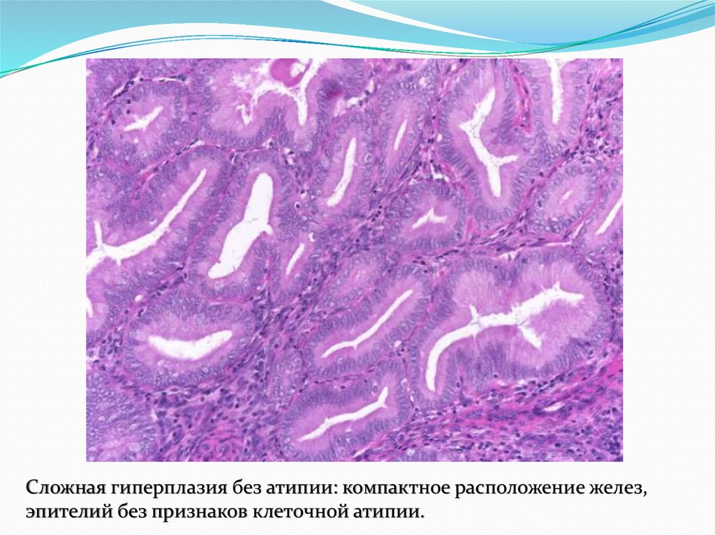 Сложная гиперплазия эндометрия