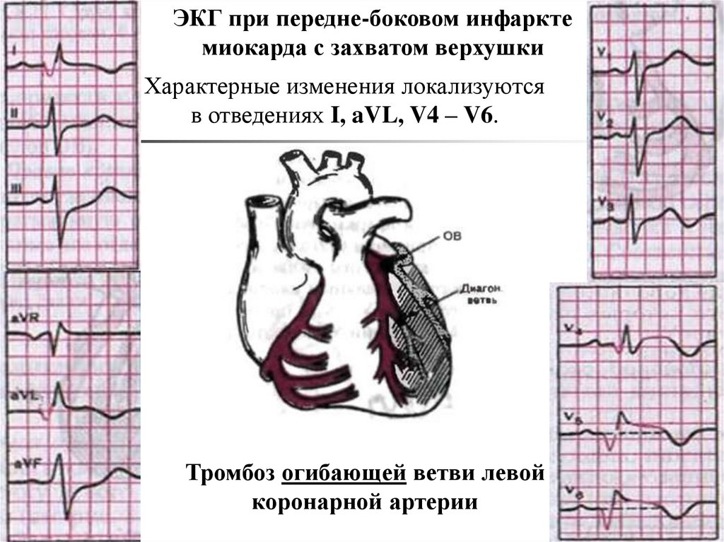 Изменение передней стенки левого желудочка. Инфаркт миокарда передней локализации ЭКГ. Инфаркт боковой стенки на ЭКГ. Верхушечный инфаркт миокарда на ЭКГ. Старый инфаркт миокарда передней стенки ЭКГ.