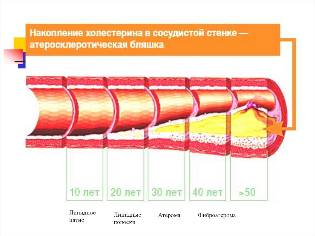 Бляшки в сосудах шейного отдела чем опасны. Виды атеросклеротических бляшек. Типы атеросклеротической бляшки. Накопление холестерина в сосудистой стенке.