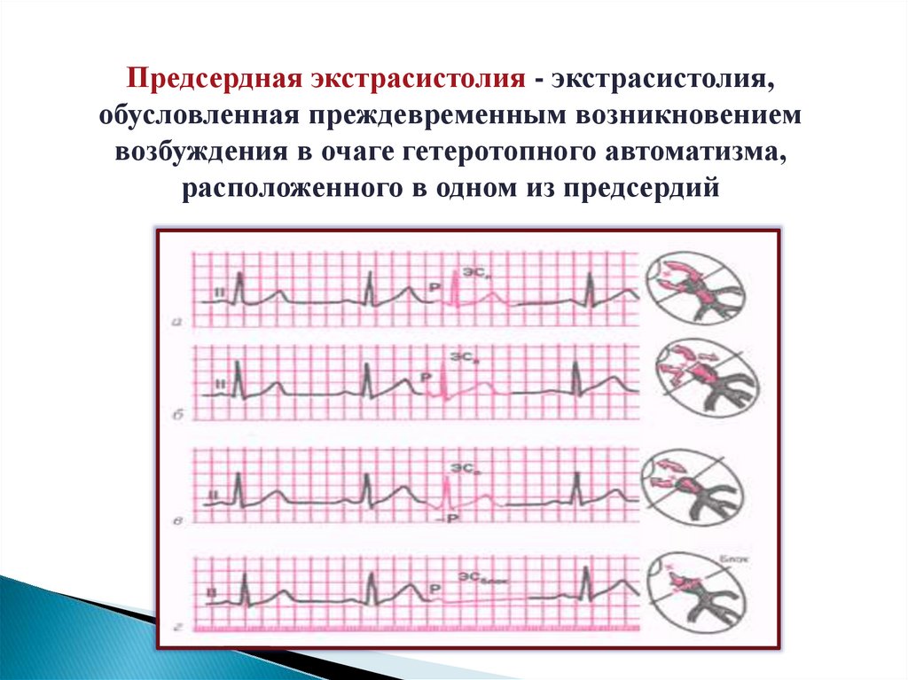 Экстрасистолии: диагностика, лечение, профилактика - презентация онлайн