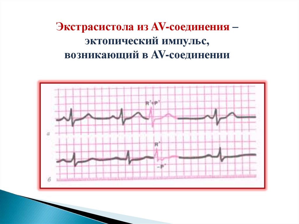 Экстрасистолии: диагностика, лечение, профилактика - презентация онлайн