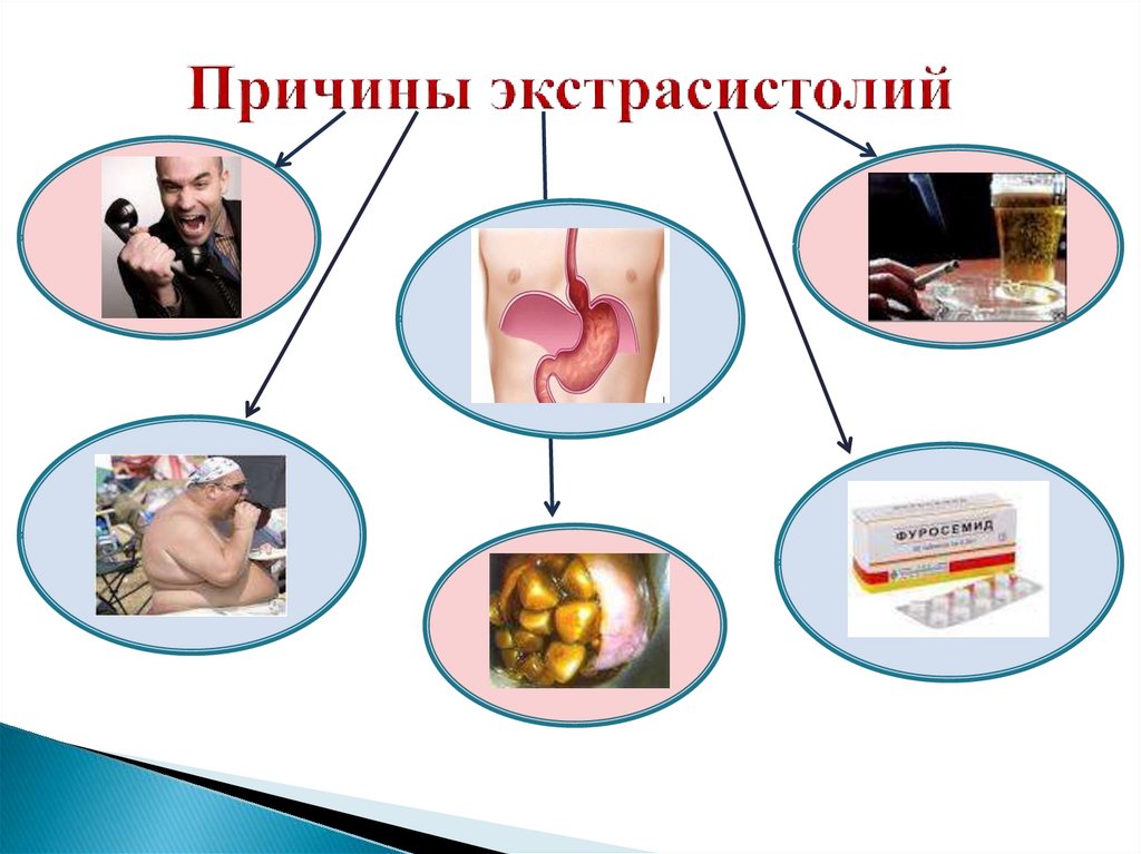 Причины экстрасистолий