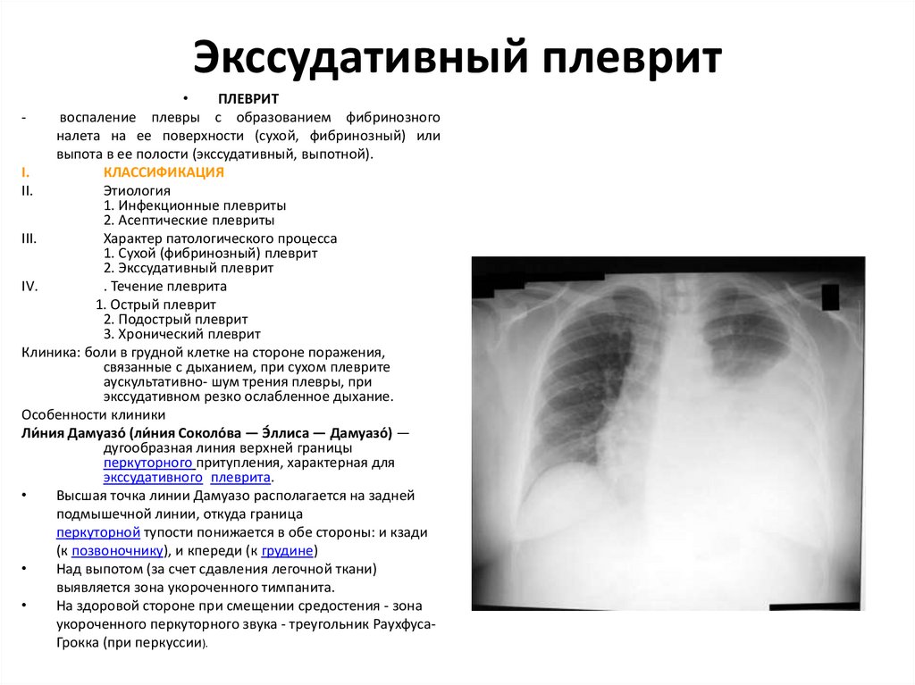 Экссудативный плеврит рентгенологическая картина