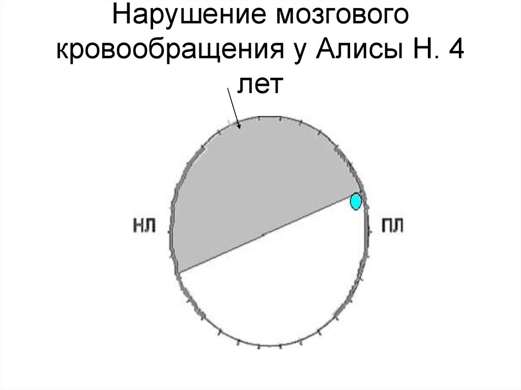 Нарушение мозгового кровообращения у Алисы Н. 4 лет