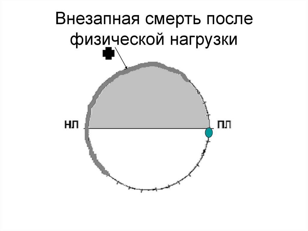 Внезапная смерть после физической нагрузки