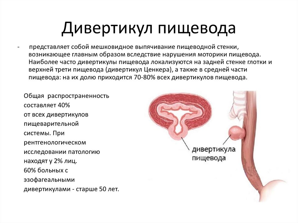 Презентация дивертикул пищевода