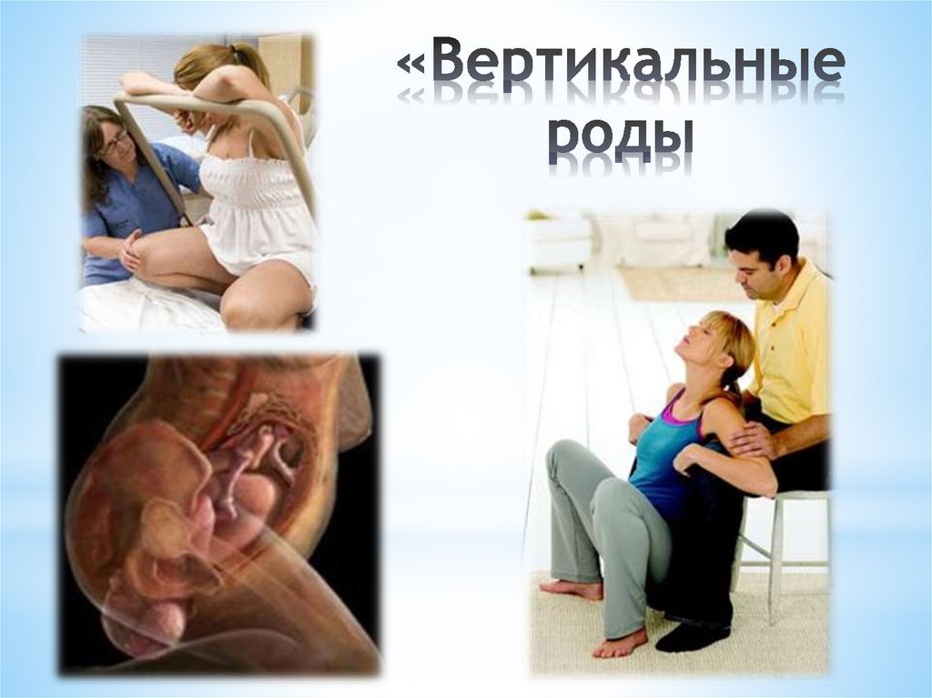 «Вертикальные роды