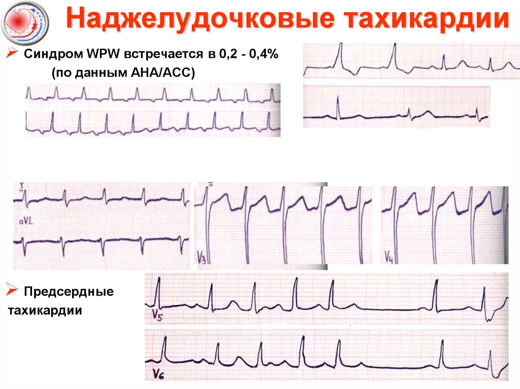 Экстрасистолия карта вызова