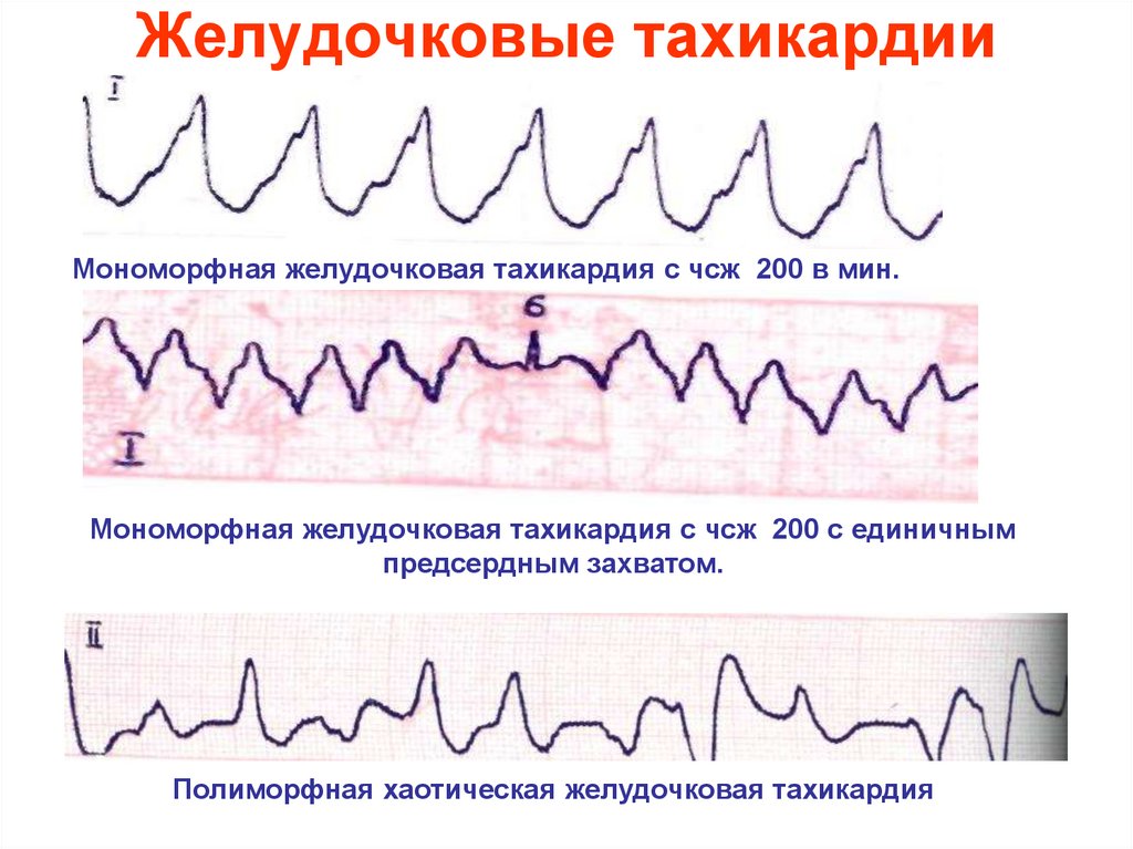 Желудочковая тахикардия картинки