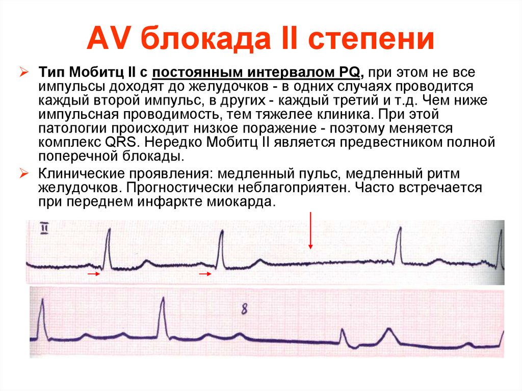 Ав блокада. АВ блокада 2 степени Мобитц 2 на ЭКГ. Атриовентрикулярная блокада 2 степени Мобитц 2 на ЭКГ. АВ блокада 2 степени Мобитц 1 на ЭКГ. Аб блокада 2 степени Мобитц 1 на ЭКГ.