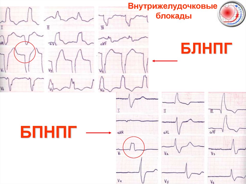 Экг под. ЭКГ блокады шпаргалка. Внутрижелудочковые блокады на ЭКГ. ЭКГ при внутрижелудочковых блокадах. Блокада левой ножки пучка Гиса мкб 10.