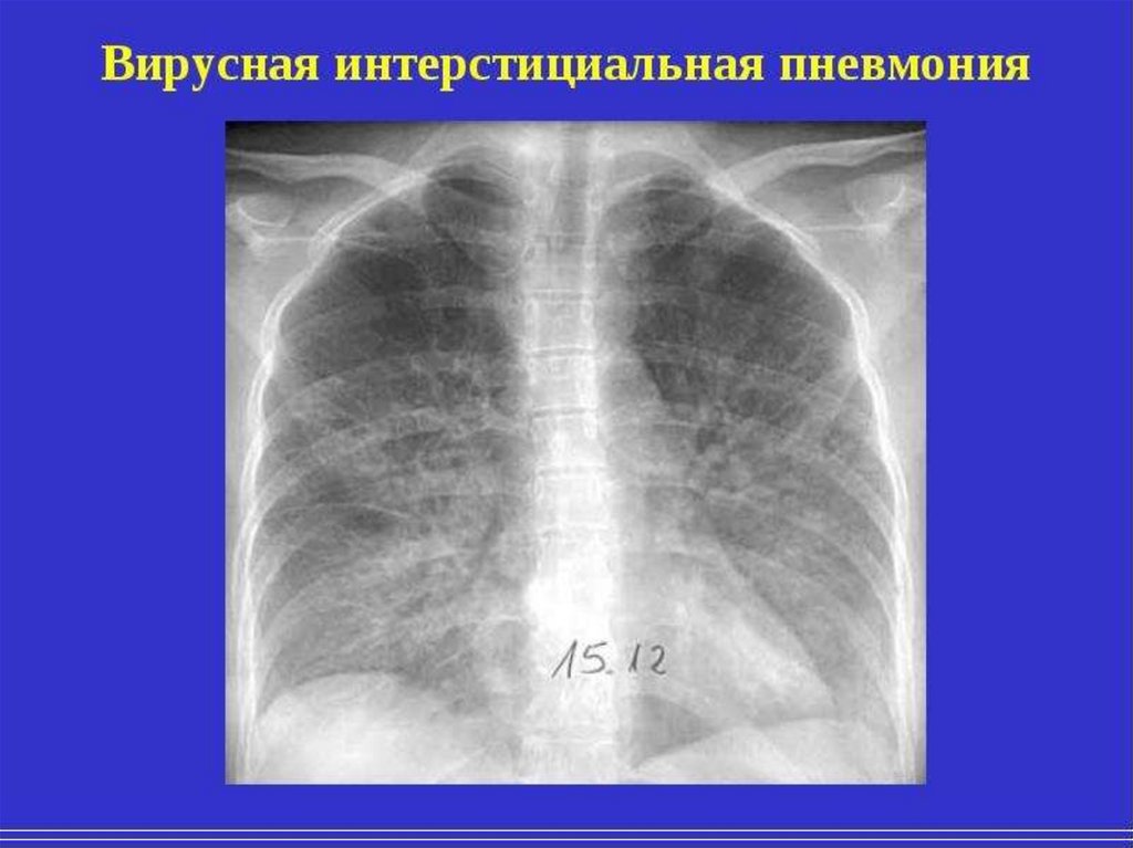 Признаки пневмонии на рентгене