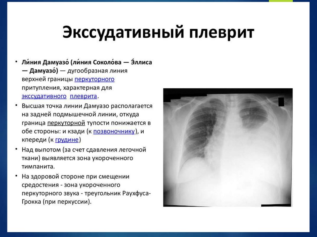 При выпотном перикардите на рентгенограмме наблюдается легочный рисунок тест ответ