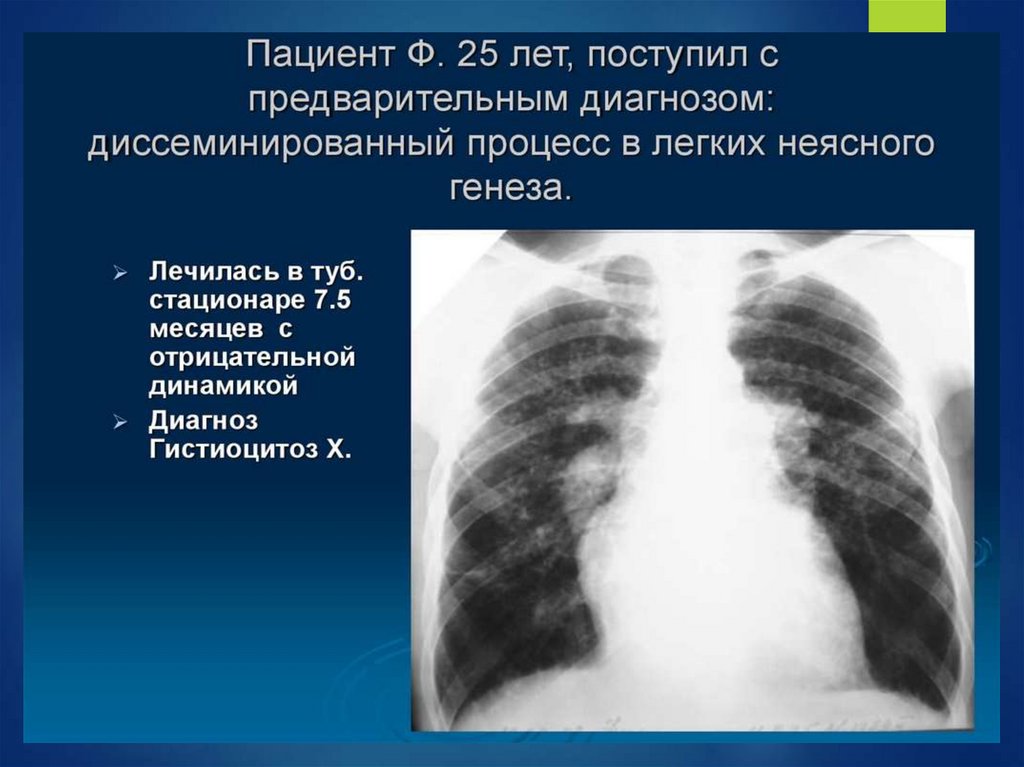 Диссеминирующий процесс в легких. Диссеминированный процесс в лёгких. Диссеминированных процессов в легких. Двусторонняя диссеминация легких.