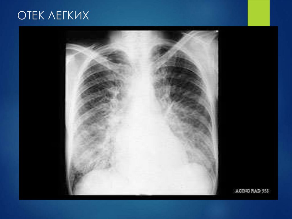 ОТЕК ЛЕГКИХ