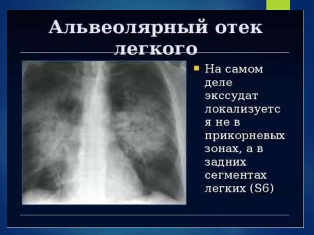 Отекают легкие симптомы. Альвеолярный отек легких. Аоюальвеолярный Отке легких. Альвеолярный отёк лёгких.