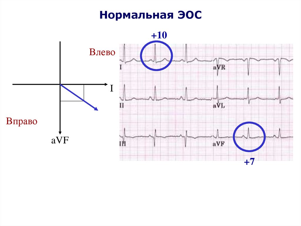 Отклонение эос влево. Нормальная ЭОС. ЭОС вправо влево. ЭОС вправо причины. ЭКГ норма ЭОС влево.