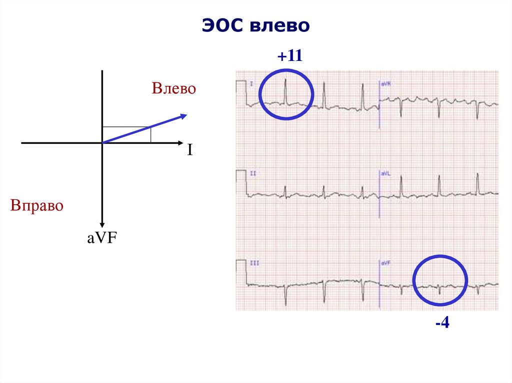 Отклонение электрической оси. ECG электрическая ось влево. ЭОС влево на ЭКГ. Резкое отклонение ЭОС влево на ЭКГ. ECG электрическая ось вправо.