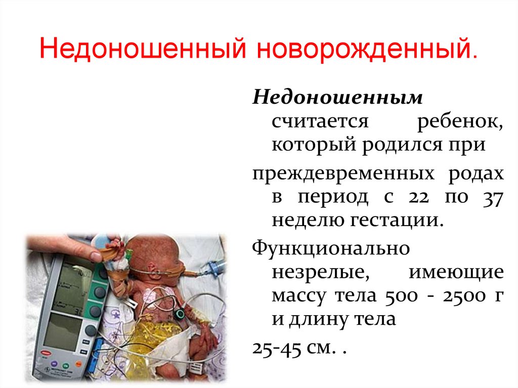 Недоношенный новорожденный.