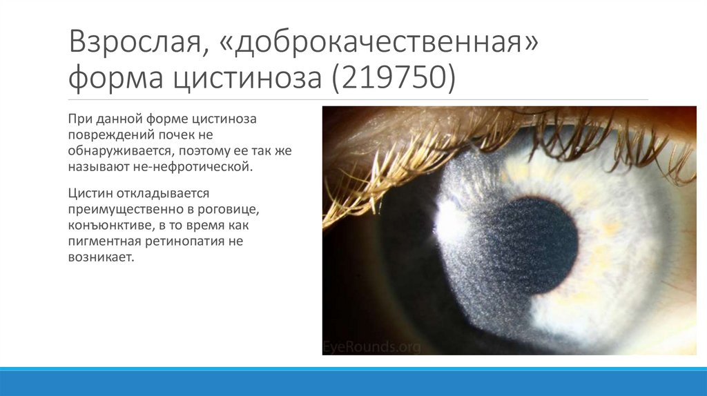 Взрослая, «доброкачественная» форма цистиноза (219750)