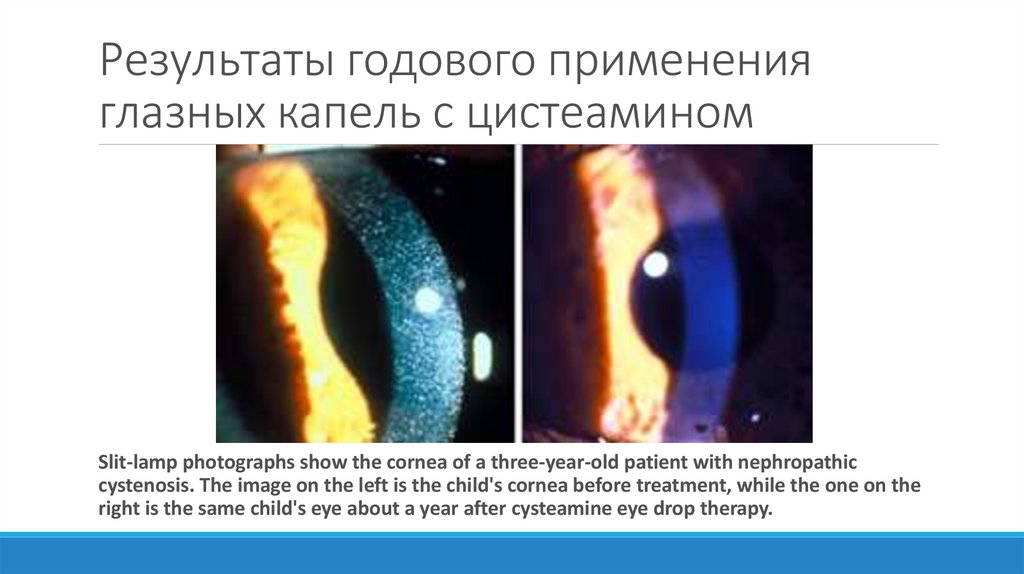 Результаты годового применения глазных капель с цистеамином