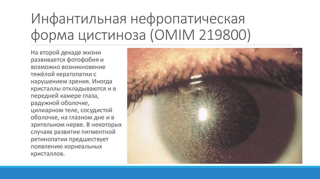 Инфантильная нефропатическая форма цистиноза (OMIM 219800)