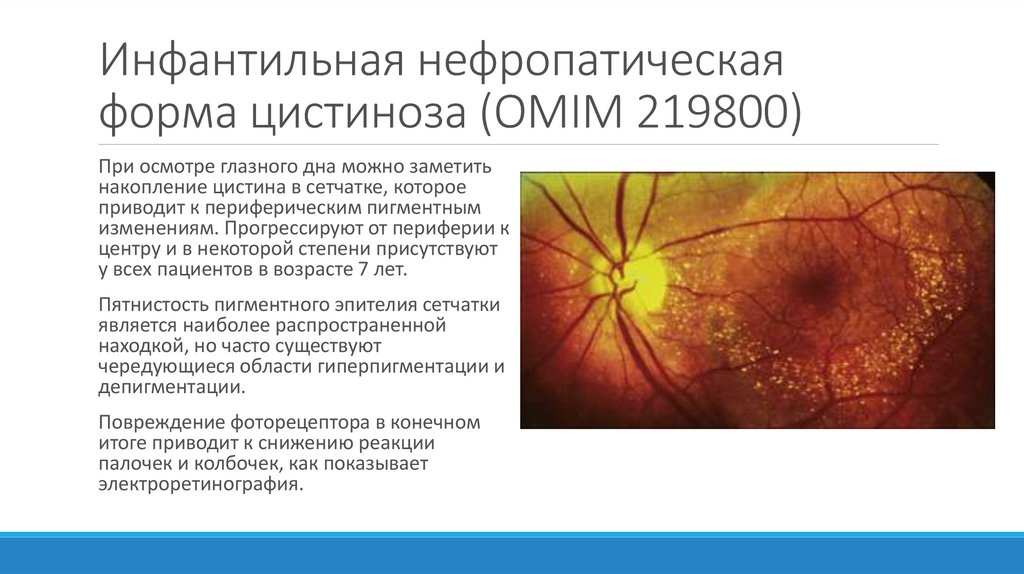 Инфантильная нефропатическая форма цистиноза (OMIM 219800)