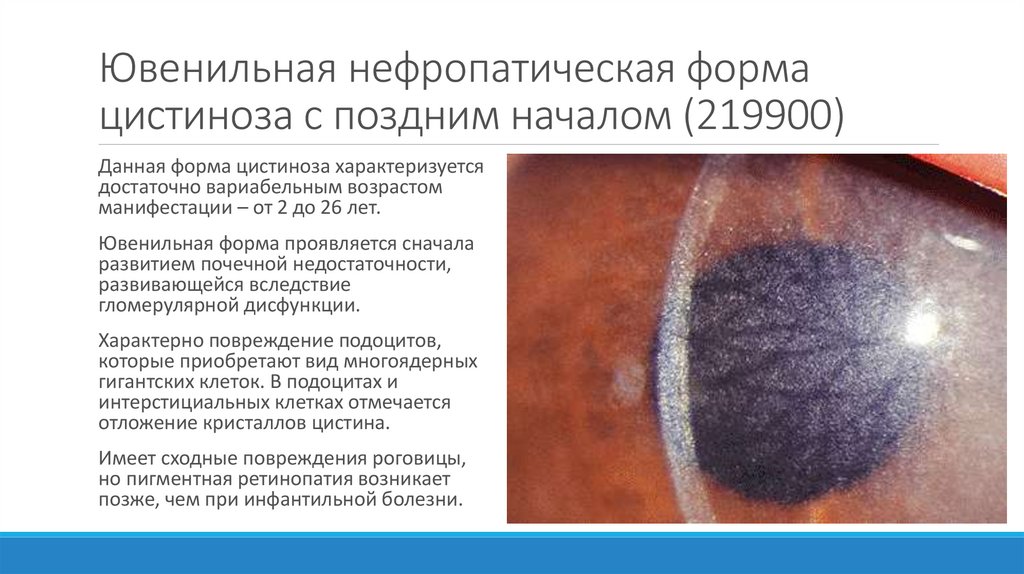 Ювенильная нефропатическая форма цистиноза с поздним началом (219900)
