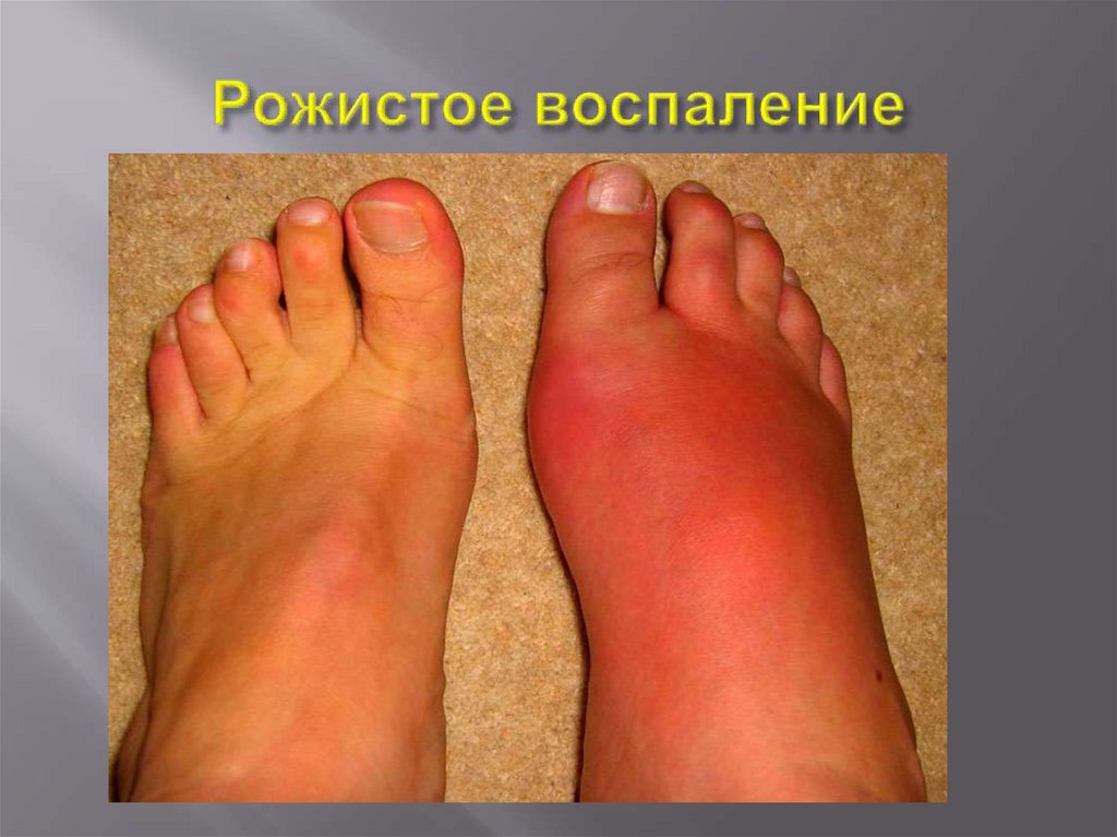 Сильное воспаление на большом пальце ноги. Воспаление на ноге - Вопрос хирургу - 03 Онлайн Воспаление Пальца Фото — Фото Картинки Опух палец на ноге больно ходить - Вопрос хирургу - 03 Онлайн