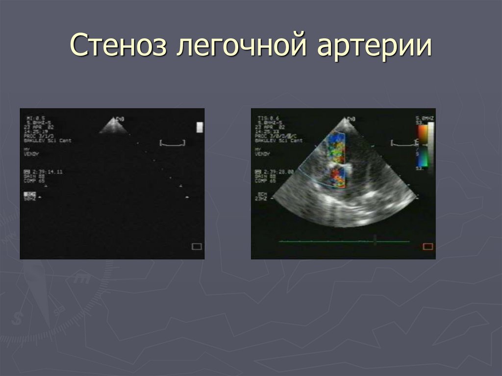 Изолированный стеноз легочной артерии презентация