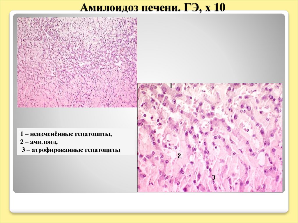 Амилоидоз печени презентация