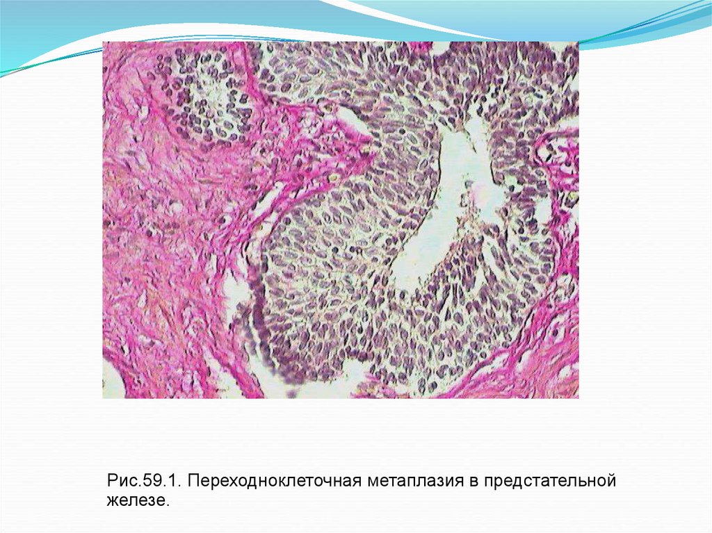 Метаплазия желез эндометрия. Базальноклеточная метаплазия в предстательной железе гистология. Уротелиальная метаплазия предстательной железы. Воспаление вокруг животного паразита.