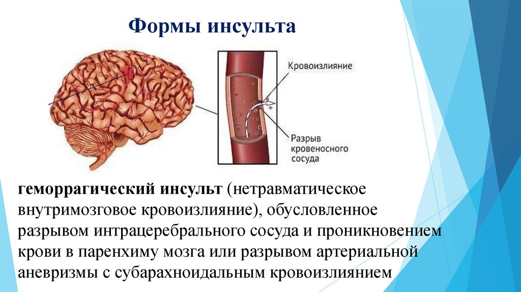 Инсульт презентация неврология