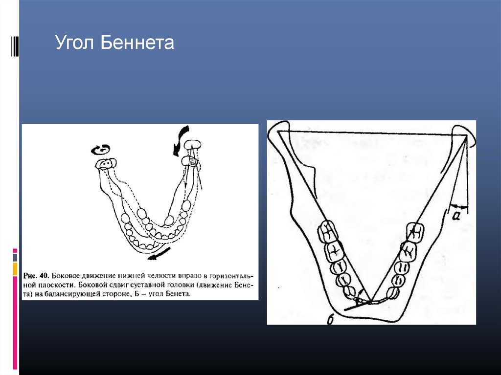 Угол пути. Угол Беннета. Угол Беннета в стоматологии. Движение Беннета. .Боковая окклюзия .угол Беннета.