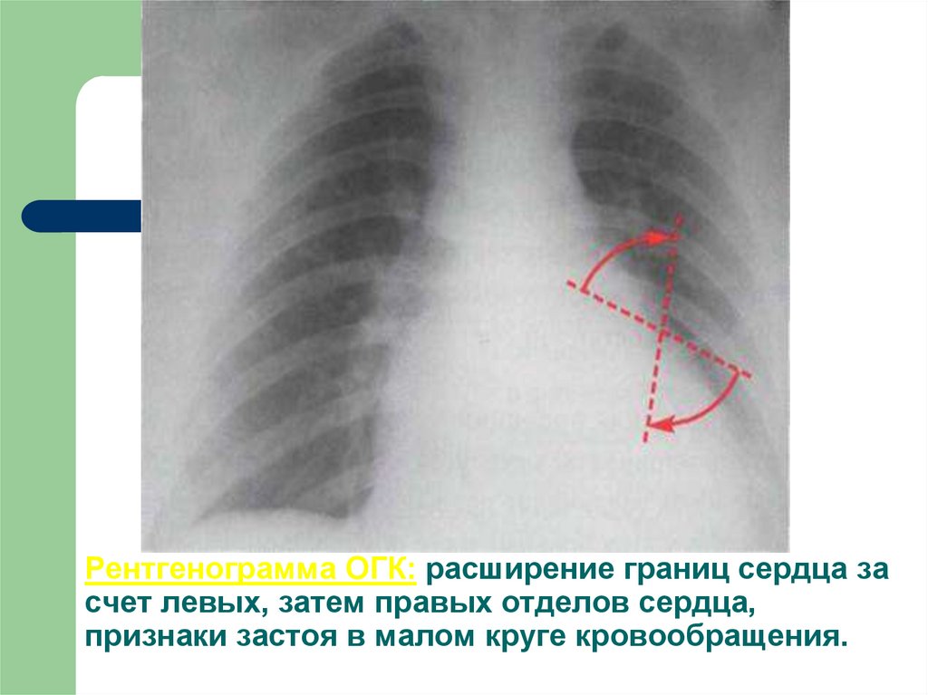 Рентгенограмма ОГК: расширение границ сердца за счет левых, затем правых отделов сердца, признаки застоя в малом круге