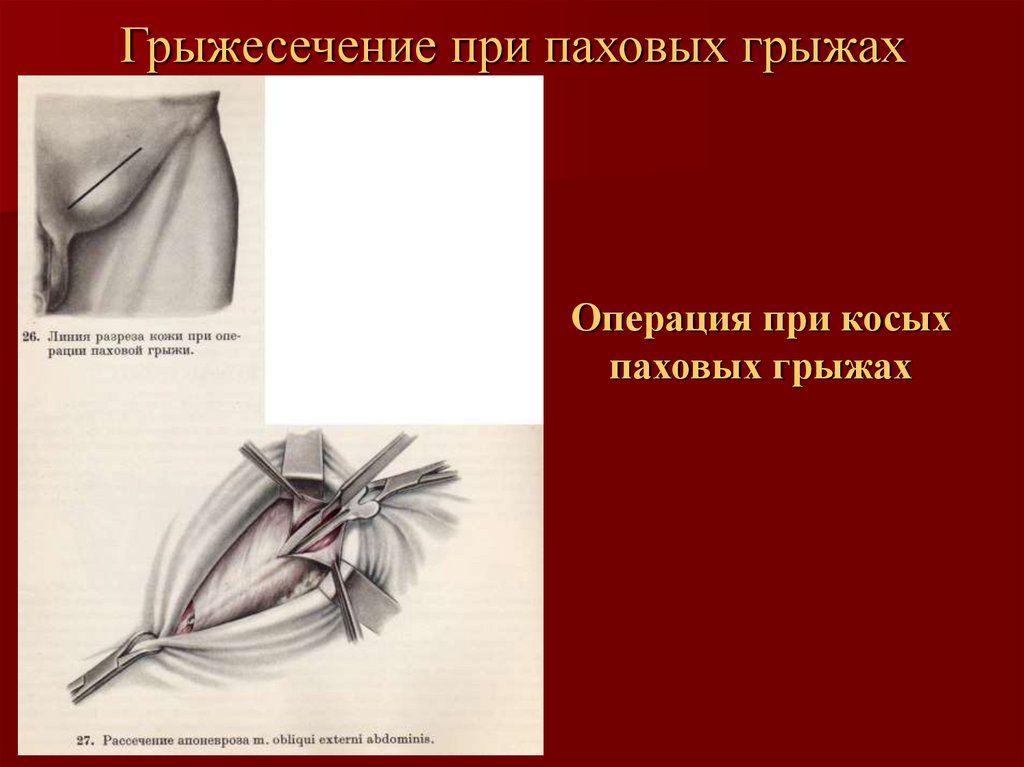 Пластика пахового канала по кимбаровскому