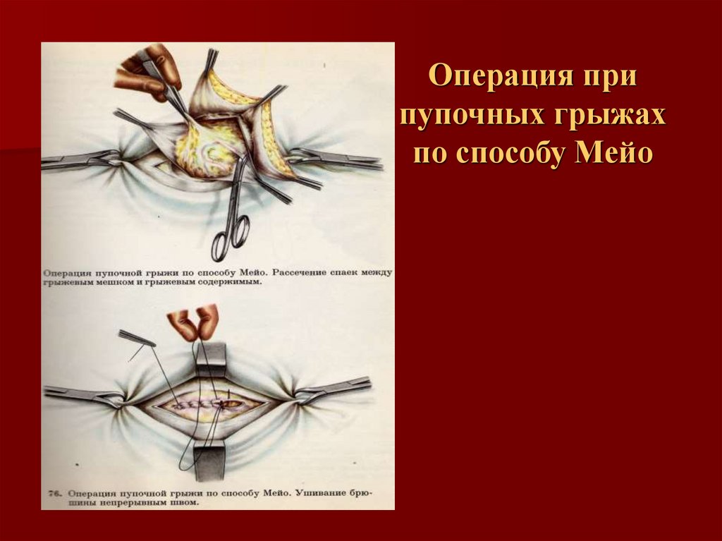 Грыжа белой линии живота лечение