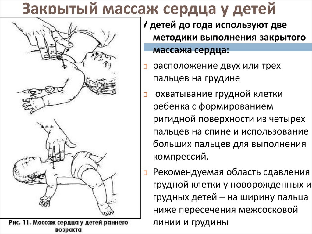 Закрытый массаж сердца