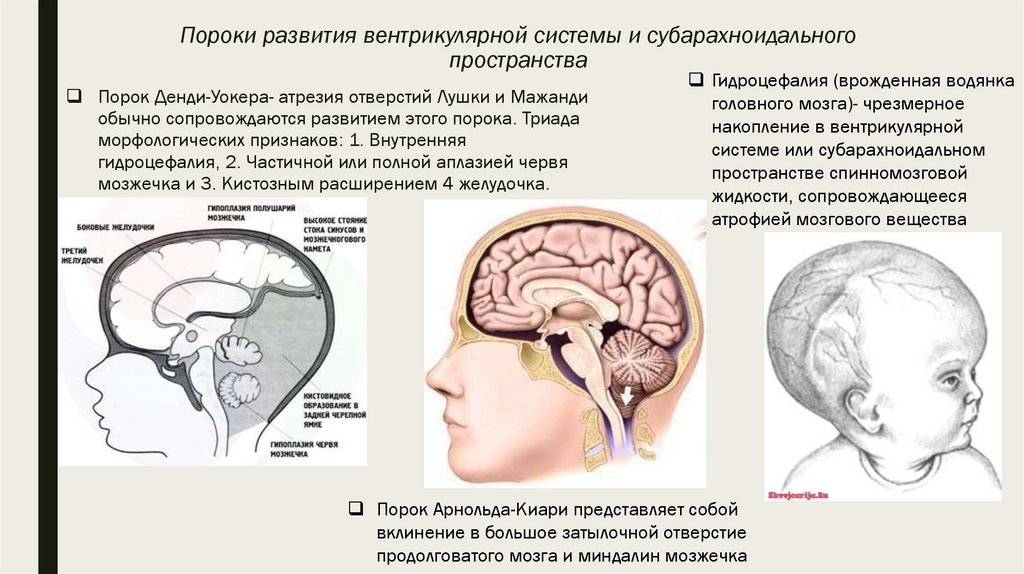 Расширения субарахноидальных пространств заместительного характера