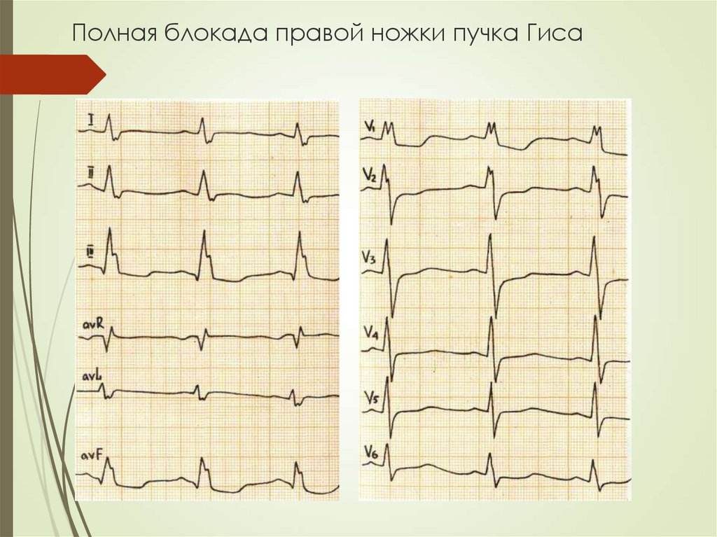 Блокада левой ножки пучка