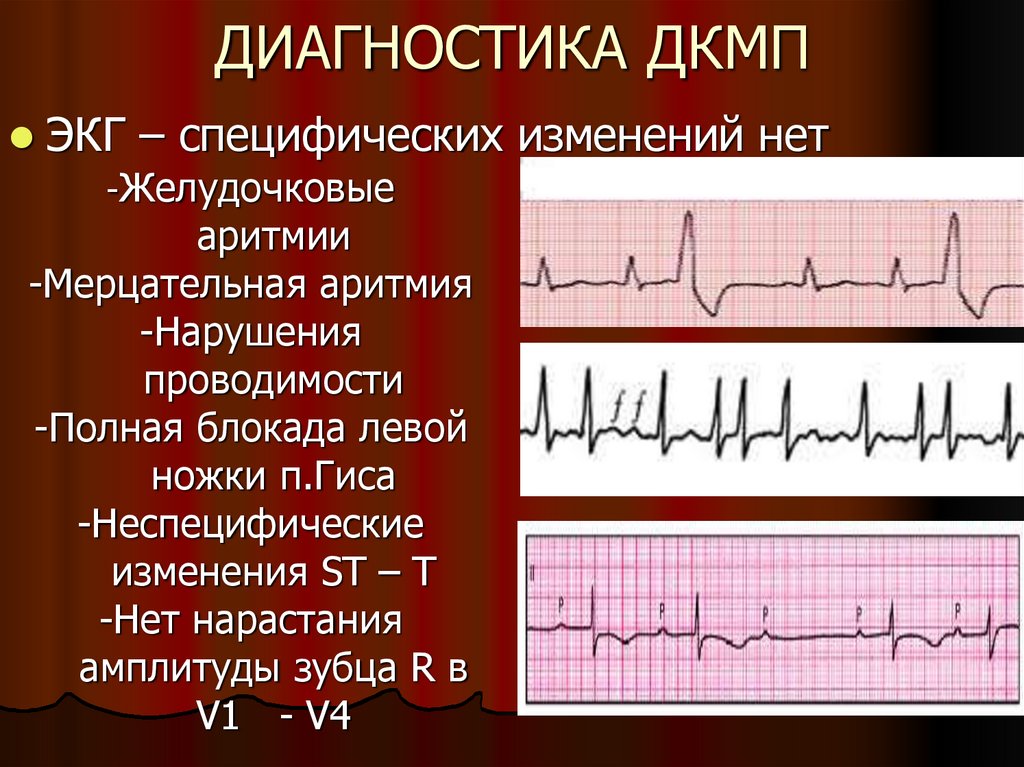 Экг при дилатационной кардиомиопатии фото