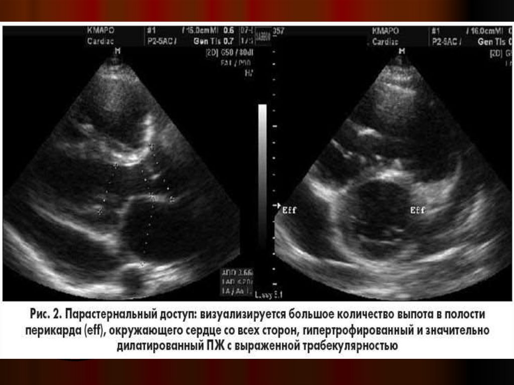Жидкость в перикарде. Экссудативный перикардит эхокардиография. Острый экссудативный перикардит ЭХОКГ. Тампонада сердца на ЭХОКГ.