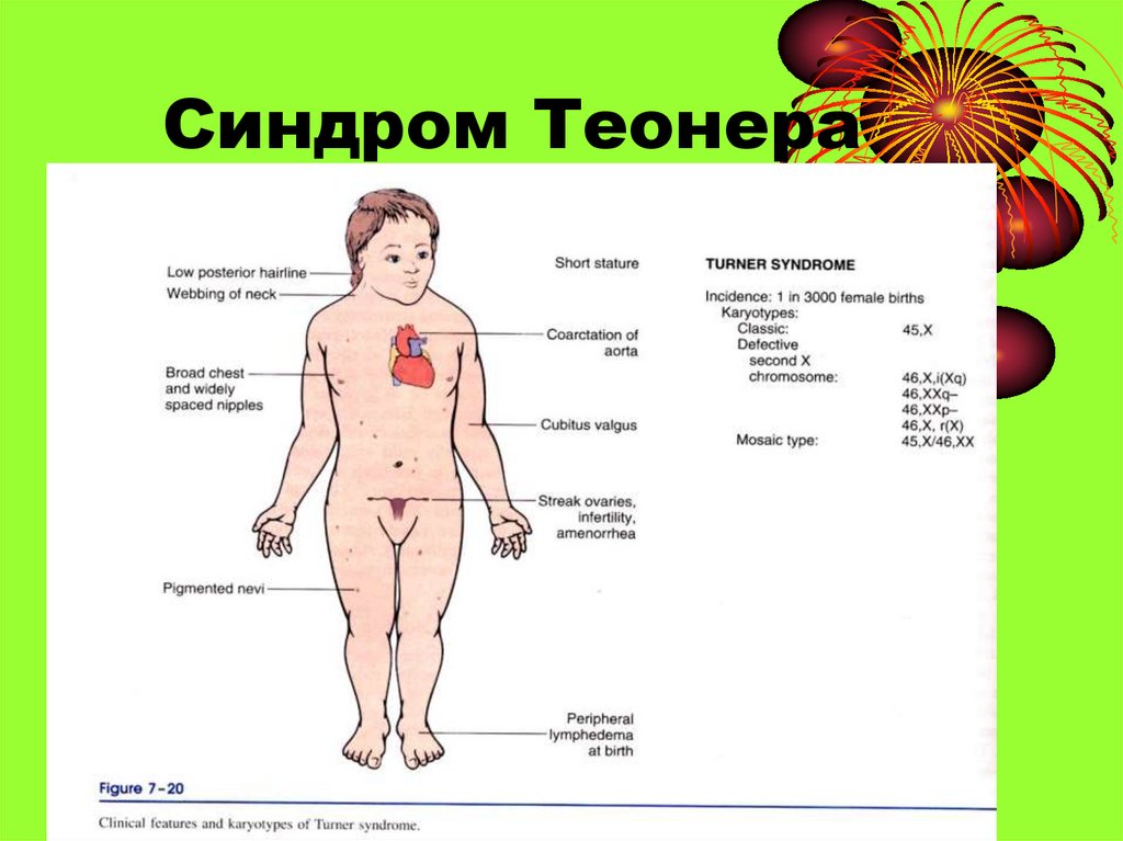 Шерешевский тернер мкб