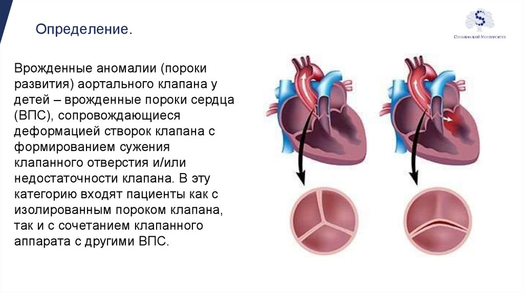 Склеродегенеративный порок аортального клапана