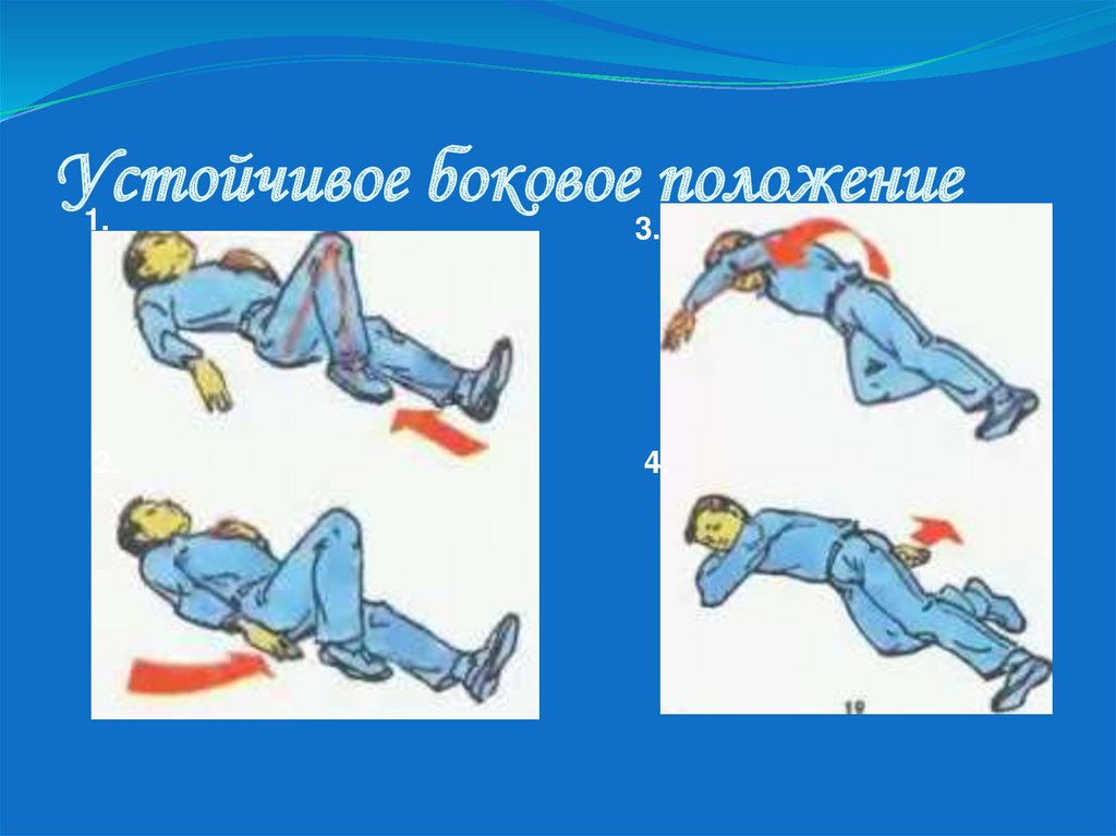 Перевод в устойчивое боковое положение. Устойчивое боковое положение. Устойчивое боковое положение пострадавшего. Стабильное боковое положение травма. Первая помощь устойчивое боковое положение.