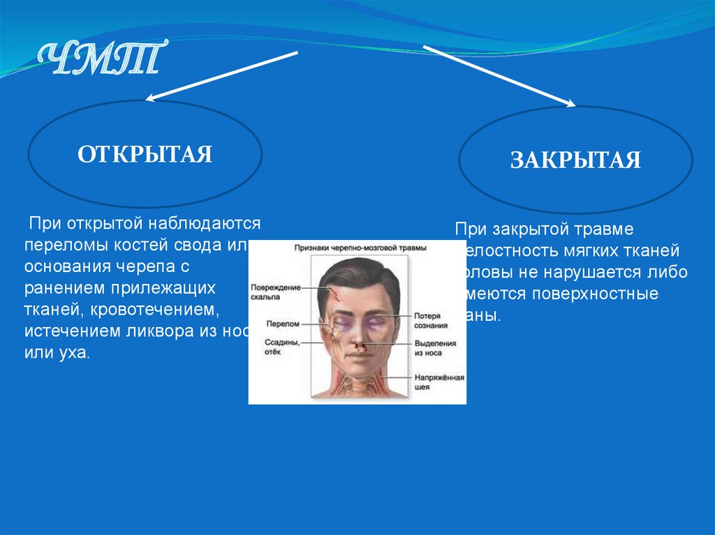 Какова помощь при черепно мозговой травме